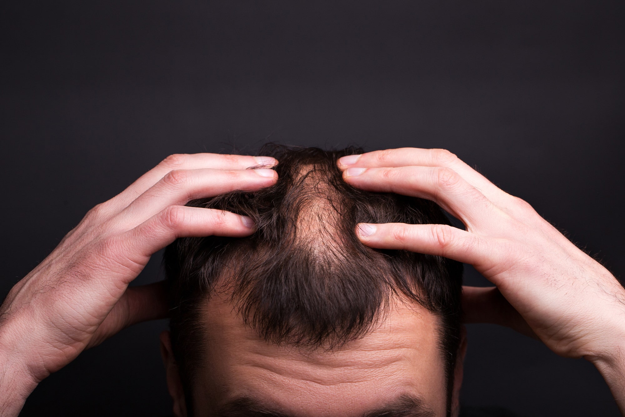 Greffe de cheveux à Nice