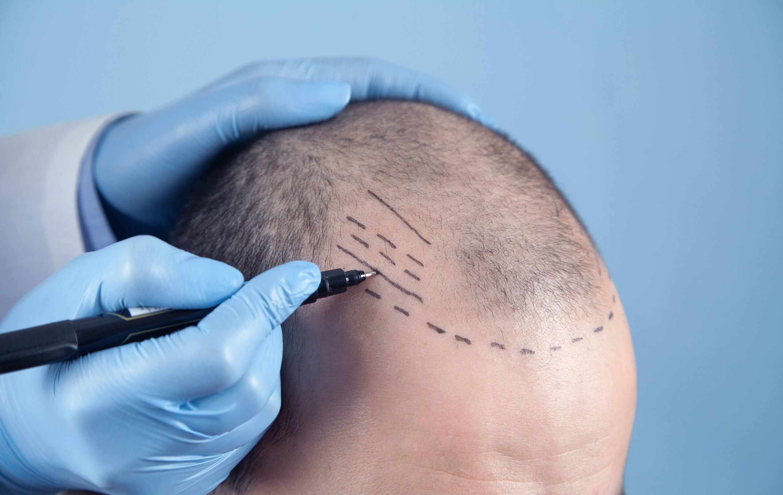 FUE vs DHI : Quelle technique de greffe capillaire est la plus adaptée à votre profil ?