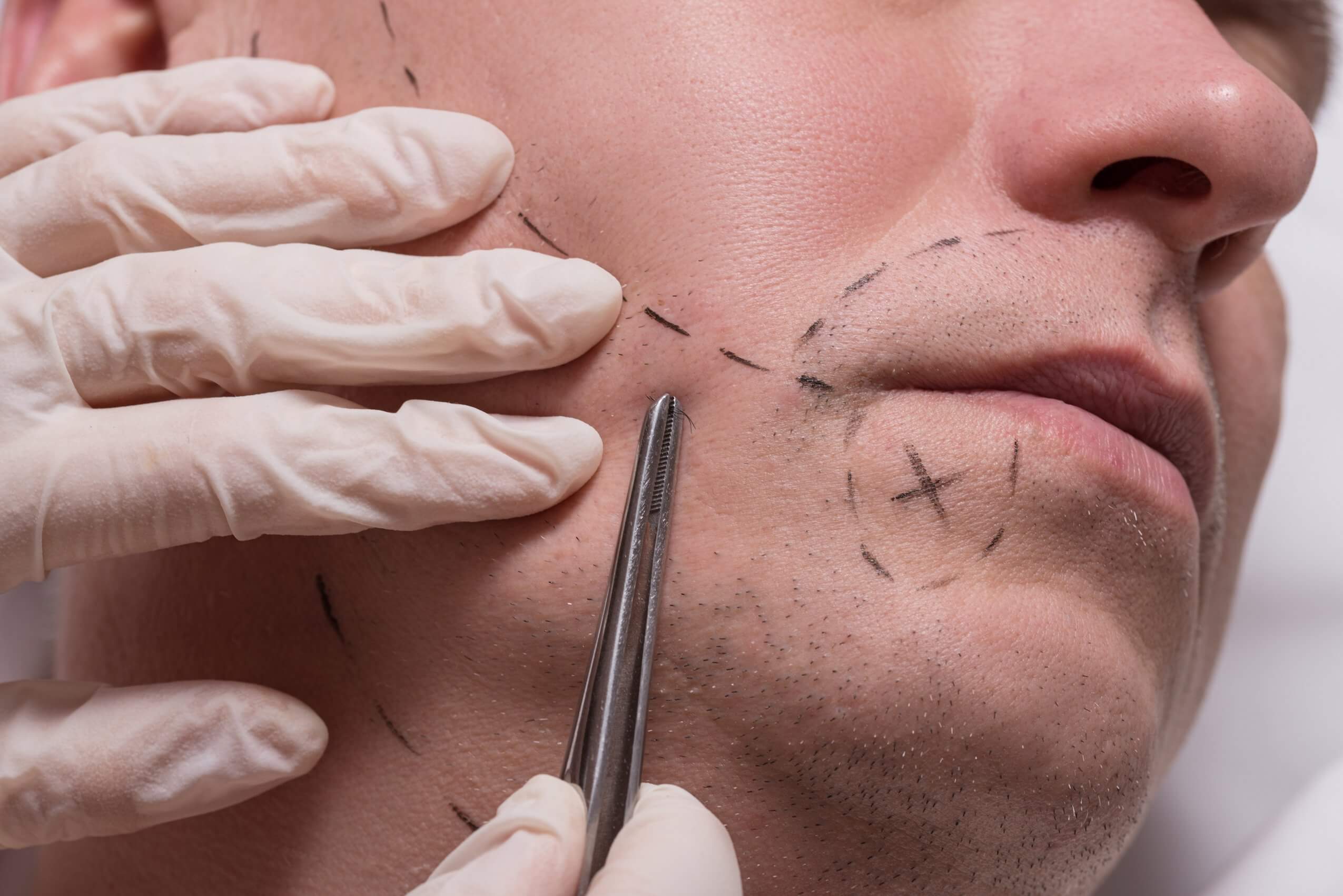 Greffe de barbe : que peut-on vraiment attendre ?
